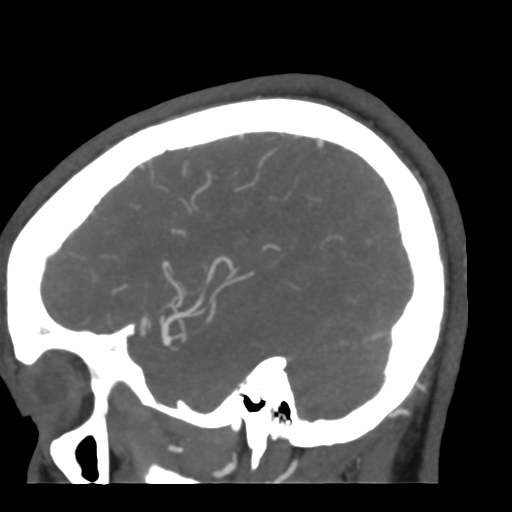 Cerebral arteriovenous malformation (Radiopaedia 39259-41505 Sagittal 15).png