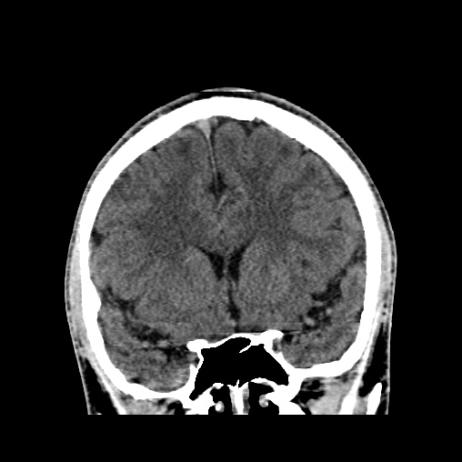 Cerebral arteriovenous malformation (Radiopaedia 61964-70028 Coronal non-contrast 23).jpg