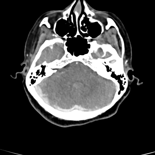 Cerebral arteriovenous malformation (Radiopaedia 73830-84645 B 75).jpg