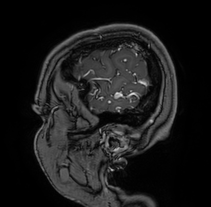 Cerebral arteriovenous malformation (Radiopaedia 74411-85654 Sagittal T1 C+ 8).jpg