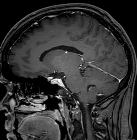 Cerebral arteriovenous malformation (Radiopaedia 74411-85746 Sagittal T1 C+ 55).jpg