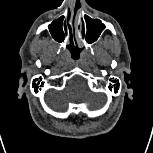 Cerebral arteriovenous malformation (Radiopaedia 78188-90746 Axial non-contrast 20).jpg