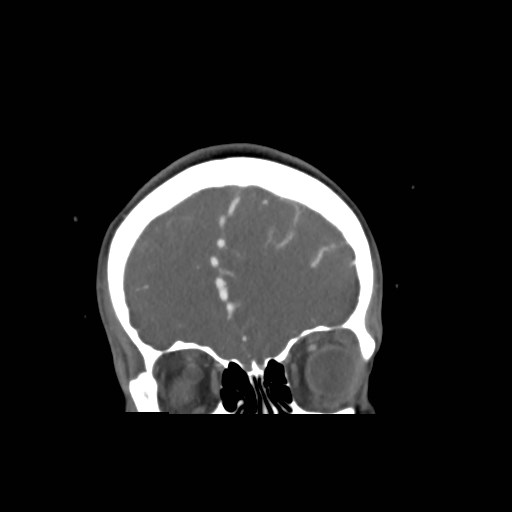 File:Cerebral arteriovenous malformation (Radiopaedia 79677-92888 B 5).jpg