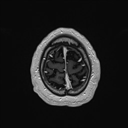 Cerebral arteriovenous malformation (Radiopaedia 84015-99245 Axial T1 C+ 140).jpg