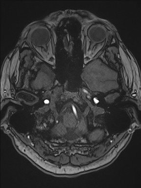Cerebral arteriovenous malformation (Radiopaedia 84015-99245 Axial TOF 63).jpg
