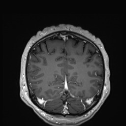 Cerebral arteriovenous malformation (Radiopaedia 84015-99245 Coronal T1 C+ 129).jpg