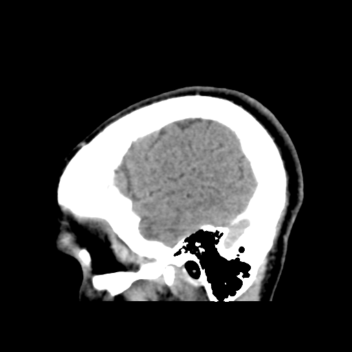 Cerebral arteriovenous malformation (Spetzler-Martin grade 2) (Radiopaedia 41262-44076 A 52).png