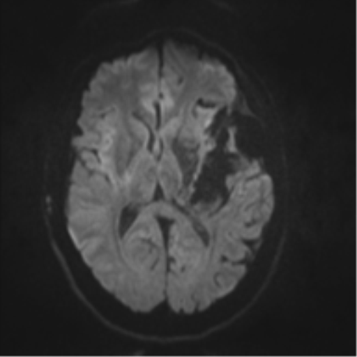 File:Cerebral arteriovenous malformation - huge (Radiopaedia 35734-37272 Axial DWI 35).png