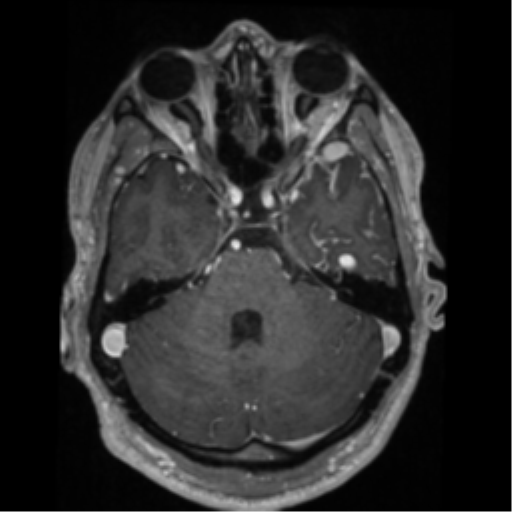 Cerebral arteriovenous malformation - huge (Radiopaedia 35734-37272 Axial T1 C+ 20).png