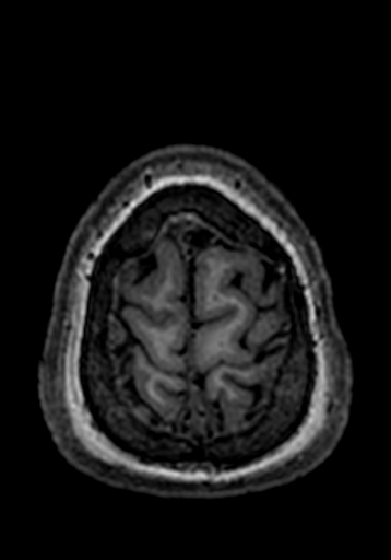 File:Cerebral arteriovenous malformation at posterior body of corpus callosum (Radiopaedia 74111-84925 Axial T1 11).jpg