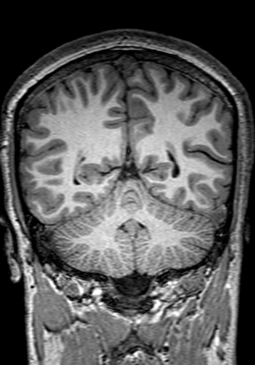 File:Cerebral arteriovenous malformation at posterior body of corpus callosum (Radiopaedia 74111-84925 Coronal T1 245).jpg