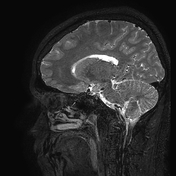 Cerebral arteriovenous malformation at posterior body of corpus callosum (Radiopaedia 74111-84925 Sagittal T2 51).jpg