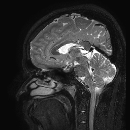 Cerebral arteriovenous malformation at posterior body of corpus callosum (Radiopaedia 74111-84925 Sagittal T2 63).jpg