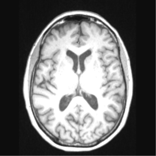 Cerebral arteriovenous malformation with hemorrhage (Radiopaedia 34422-35737 Axial T1 42).png
