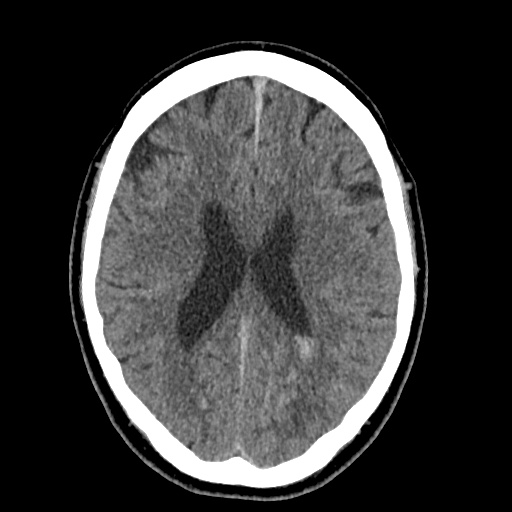 Cerebral arteriovenous malformation with lobar hemorrhage (Radiopaedia 35598-37117 Axial non-contrast 34).jpg