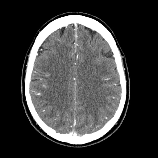 Cerebral arteriovenous malformation with lobar hemorrhage (Radiopaedia 35598-57216 A 43).jpg