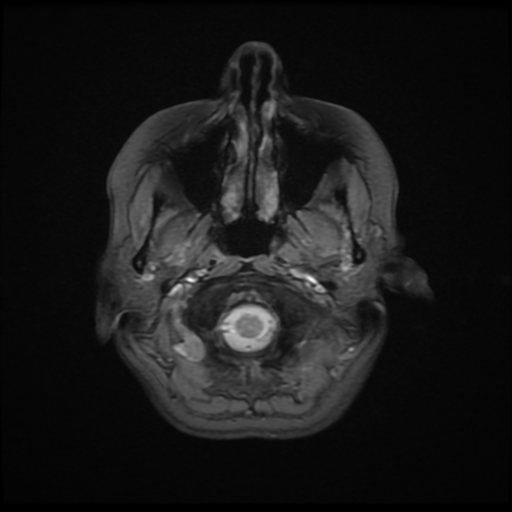 File:Cerebral autosomal dominant arteriopathy with subcortical infarcts and leukoencephalopathy (CADASIL) (Radiopaedia 41018-43768 Ax 2D MERGE 1).png