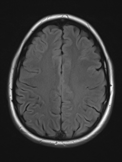 File:Cerebral cavernoma and development venous anomaly (Radiopaedia 37603-39482 Axial FLAIR 16).png