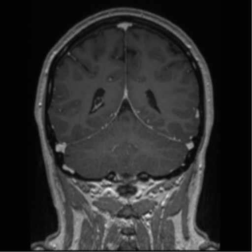 Cerebral cavernoma and development venous anomaly (Radiopaedia 37603-39482 Coronal T1 C+ 32).png