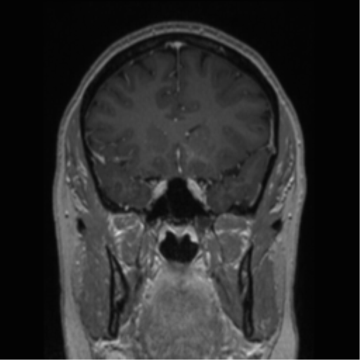 Cerebral cavernoma and development venous anomaly (Radiopaedia 37603-39482 Coronal T1 C+ 63).png