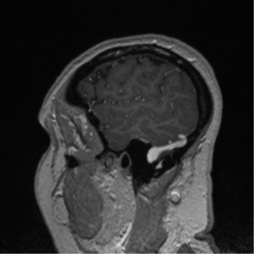 File:Cerebral cavernoma and development venous anomaly (Radiopaedia 37603-39482 Sagittal T1 C+ 17).png