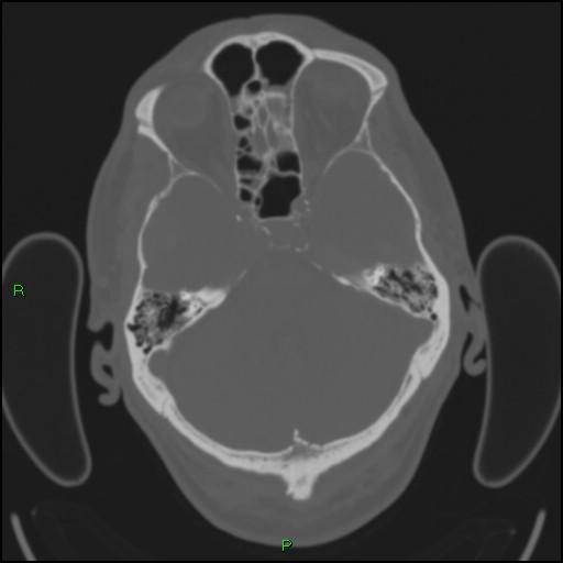 Cerebral contusions (Radiopaedia 33868-35039 Axial bone window 55).jpg