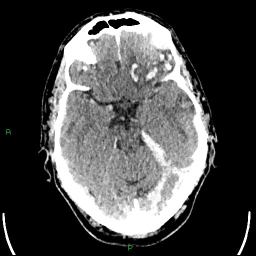 Cerebral contusions (Radiopaedia 33868-35039 Axial non-contrast 74).jpg