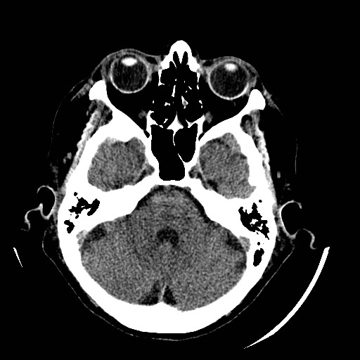 File:Cerebral edema (evolution in time) (Radiopaedia 19418-19440 non-contrast 31).jpg