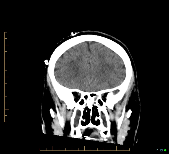 Cerebral fat embolism (Radiopaedia 85521-101220 Coronal non-contrast 20).jpg