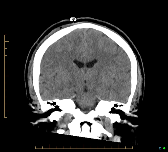 Cerebral fat embolism (Radiopaedia 85521-101224 Coronal non-contrast 34).jpg