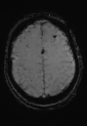 File:Cerebral hemorrhagic contusions- temporal evolution (Radiopaedia 40224-42757 D 31).png