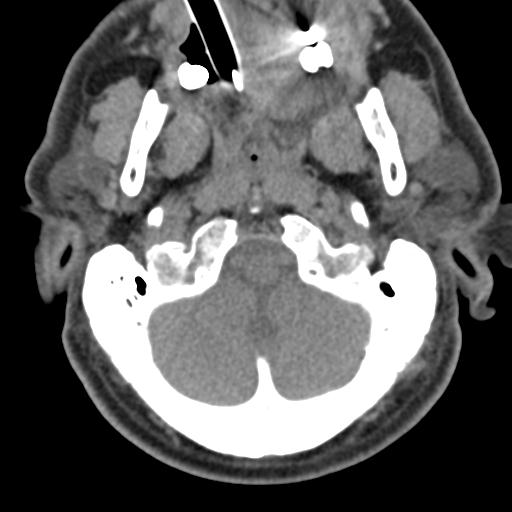 Cerebral hemorrhagic contusions and cervical spine fractures (Radiopaedia 32865-33841 F 8).jpg