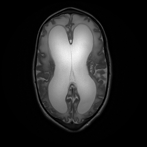 File:Cerebral manifestations of mucopolysaccharidosis type I (Radiopaedia 59171-66487 Axial T2 13).jpg
