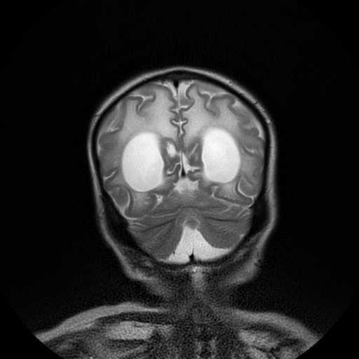 File:Cerebral manifestations of mucopolysaccharidosis type I (Radiopaedia 59171-66487 Coronal T2 18).jpg