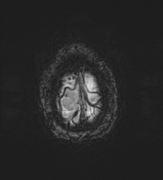 Cerebral metastasis - melanoma (Radiopaedia 54718-60954 Axial SWI 54).png