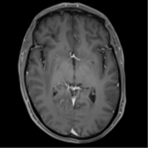 Cerebral metastasis - melanoma (Radiopaedia 54718-60954 Axial T1 C+ fat sat 25).png