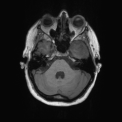 Cerebral metastasis mimicking glioblastoma (Radiopaedia 69155-78937 Axial T1 13).png