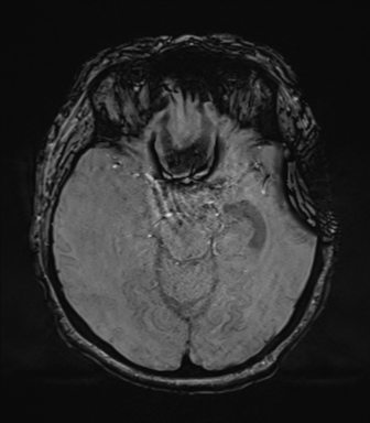 File:Cerebral metastasis to basal ganglia (Radiopaedia 81568-95413 Axial SWI 32).png
