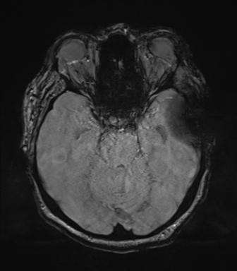 Cerebral metastasis to basal ganglia (Radiopaedia 81568-95413 Axial SWI magnitude 27).png