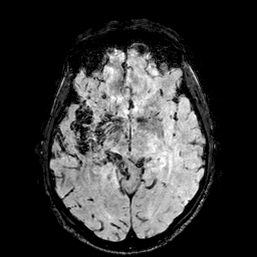 Cerebral parenchymal arteriovenous malformation (Radiopaedia 27280-27456 Axial SWI 49).jpg
