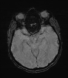 File:Cerebral toxoplasmosis (Radiopaedia 43956-47461 Axial SWI 16).jpg