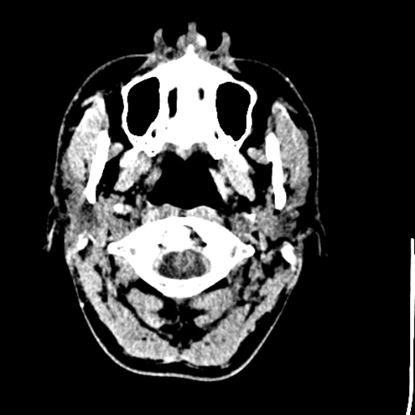 Cerebral toxoplasmosis (Radiopaedia 53993-60131 Axial non-contrast 4).jpg