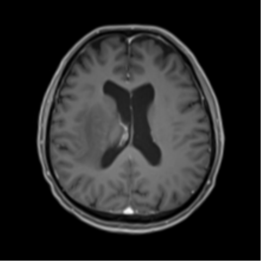 Cerebral toxoplasmosis (Radiopaedia 54575-60804 Axial T1 C+ 34).png
