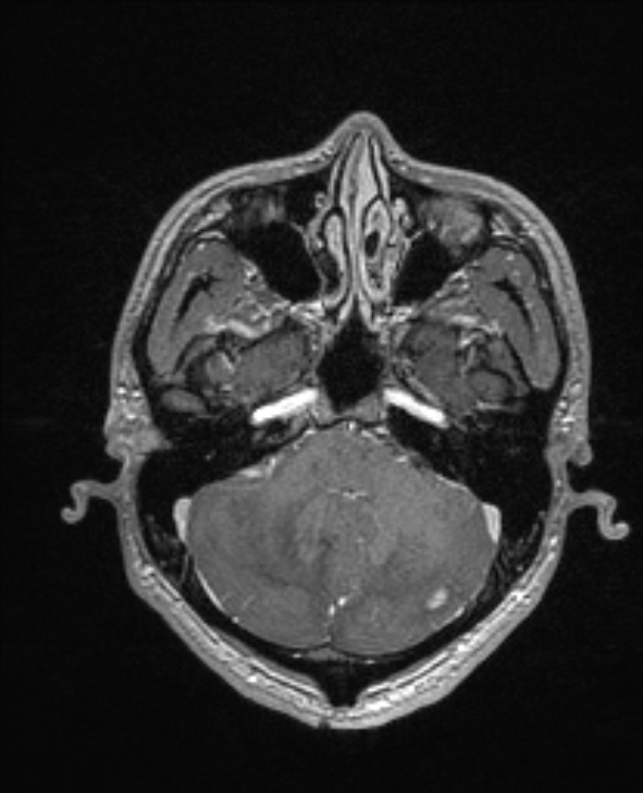 Cerebral toxoplasmosis (Radiopaedia 85779-101597 Axial T1 C+ 38).jpg