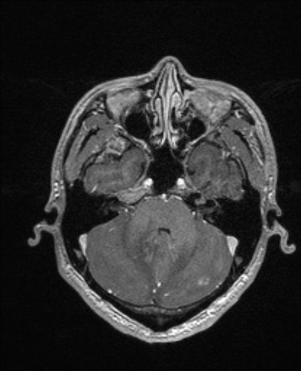 Cerebral toxoplasmosis (Radiopaedia 85779-101597 Axial T1 C+ 42).jpg