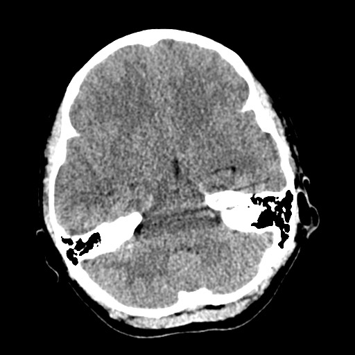 Cerebral tuberculosis with dural sinus invasion (Radiopaedia 60353-68018 Axial non-contrast 16).jpg