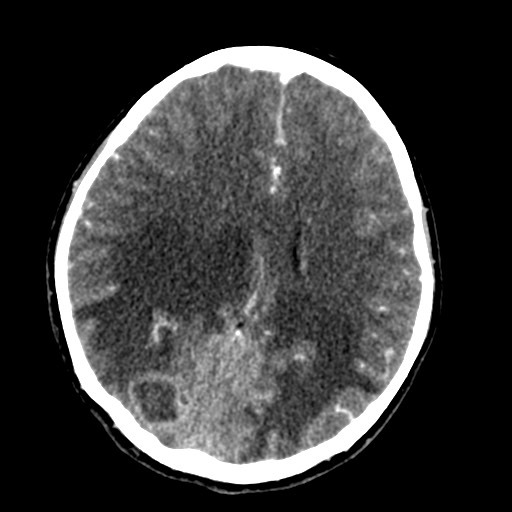 Cerebral tuberculosis with dural sinus invasion (Radiopaedia 60353-68019 Axial C+ delayed 40).jpg