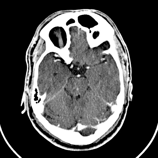 File:Cerebral venous angioma (Radiopaedia 69959-79977 B 23).jpg