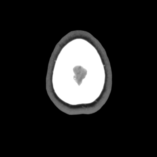 Cerebral venous infarct related to dural venous sinus thromboses (Radiopaedia 35292-36804 Axial C+ delayed 48).png