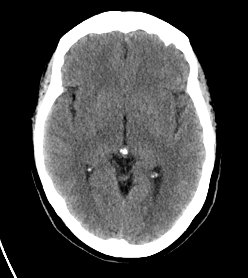 File:Cerebral venous infarct related to dural venous sinus thromboses (Radiopaedia 35292-36804 Axial non-contrast 14).png